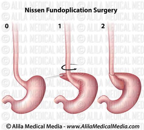 Alila Medical Media Nissen Fundoplication Surgery Medical Illustration