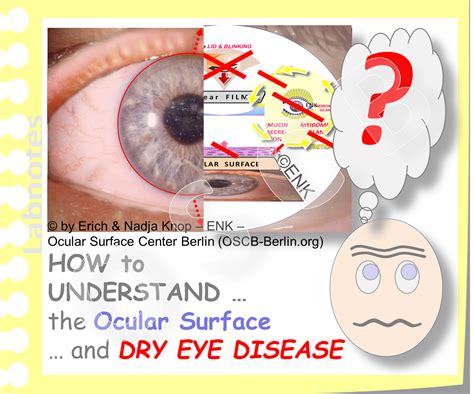 Glimpse On Dry Eye Disease Ocular Surface Center Berlin