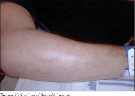 Figure 2 From Diagnosis And Management Of Eosinophilic Cellulitis Wells Syndrome A Case