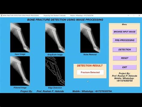 Bone Fracture Detection Using Image Processing With Source Code