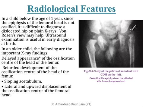 Congenital Hip Dislocation PPT