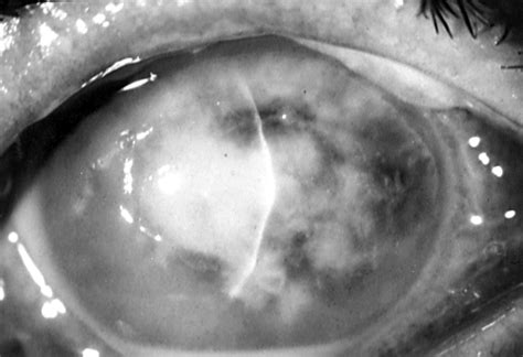 Extended Wear Contact Lens Related Bacterial Keratitis British Journal Of Ophthalmology