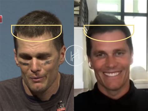 Tom Brady Hair Transplant - Hair Loss & Technical Analysis