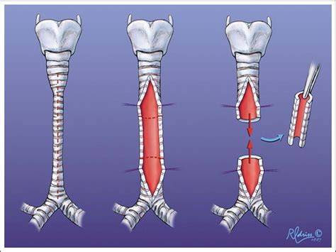 Figure 12 From A History Of Pediatric Tracheal Surgery Semantic Scholar