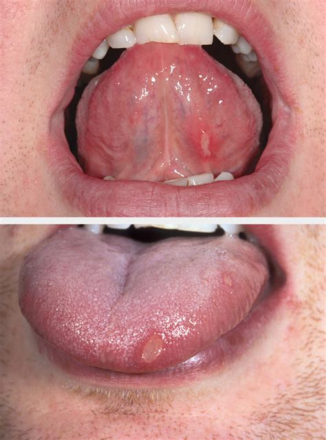 Dermatitis Herpetiformis Mouth