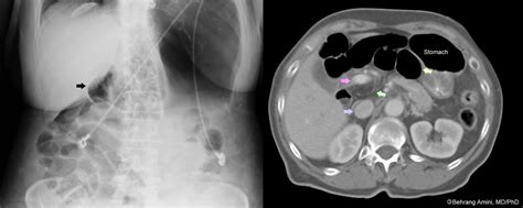 Roentgen Ray Reader: Foramen of Winslow Hernia