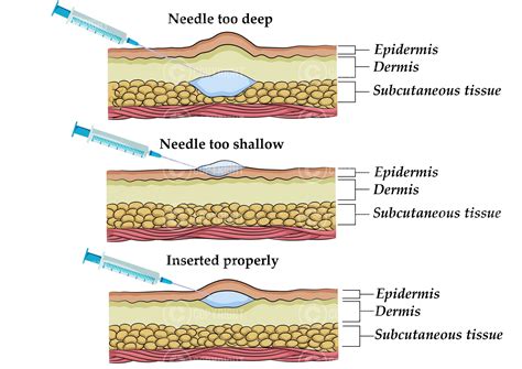 Intradermal Injection Technique Mesotherapy Skin Boosters Botox ...