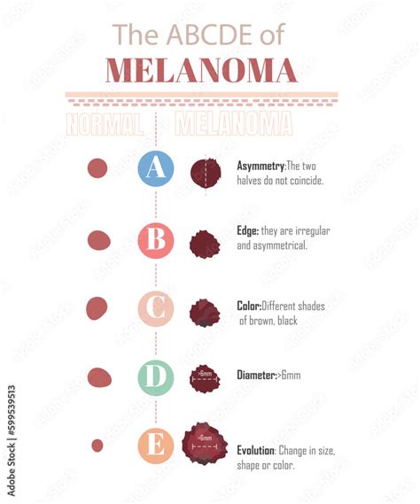 The ABCDE of melanoma, to know if you have a melanoma, on a white ...