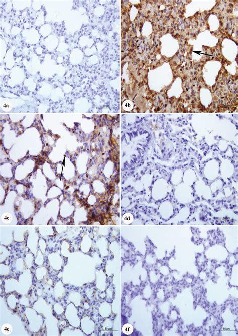 Photomicrograph Of Nuclear Factor Kappa Nf Expression Stained