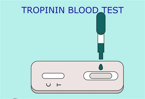 Trop T Test And Trop I Test The Best Biomarkers In Myocardial