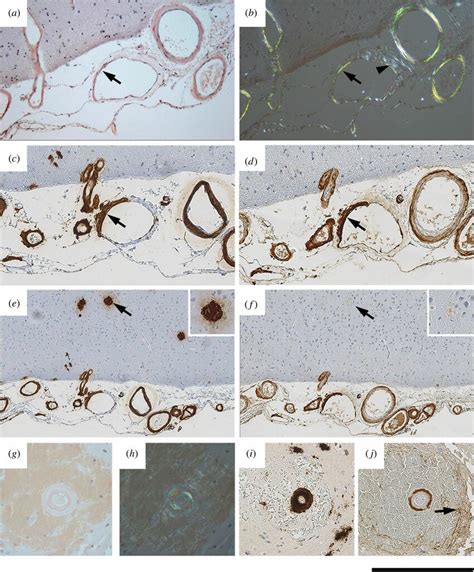 Localization Of Sap In Human Caa A B Congo Red Stained Section