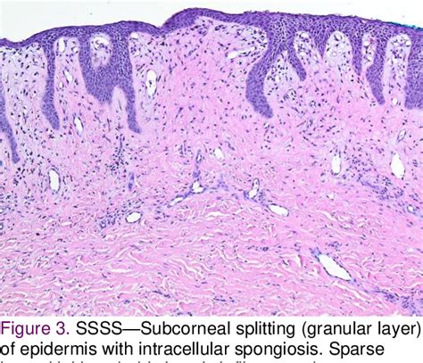 Staphylococcal Scalded Skin Syndrome Histology