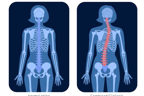 Impacto De La Escoliosis En Tu Salud Causas Síntomas Y Opciones De Tratamiento