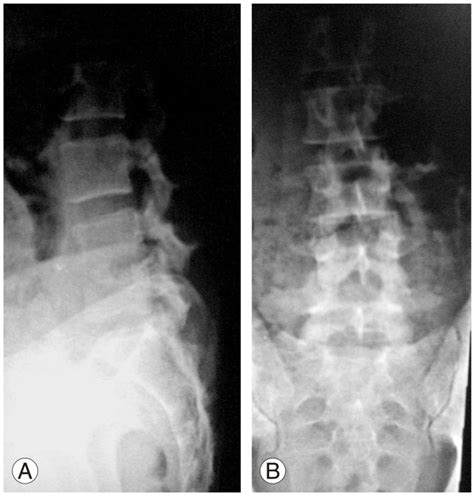 A B Anteroposterior And Lateral Views Of A 44 Year Old Male With Download Scientific Diagram