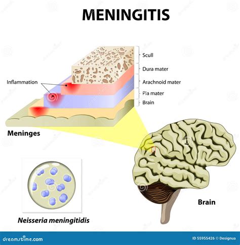 Meningitis Stock Vector Illustration Of Emergency Anatomy 55955426