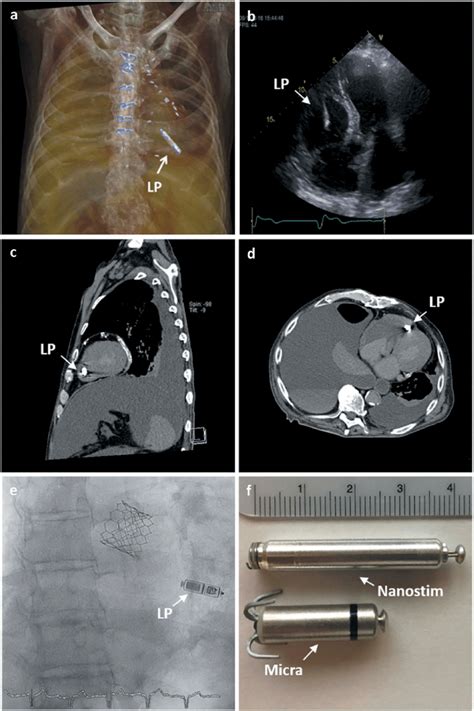 The Micra And Nanostim Leadless Pacemakers Leadless Pacemaker Therapy