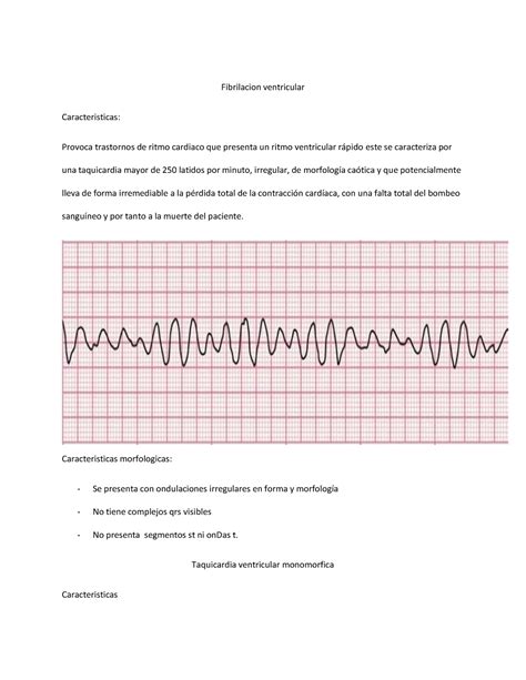 Ekg Atlas Fibrilacion Ventricular Caracteristicas Provoca Trastornos