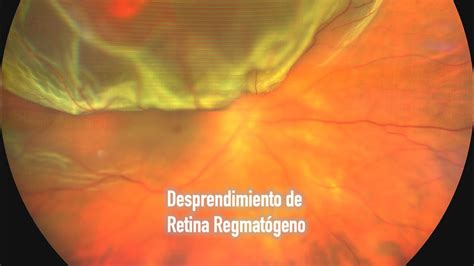 Desprendimiento De Retina Facoemulsificaci N Con Implante De Lente