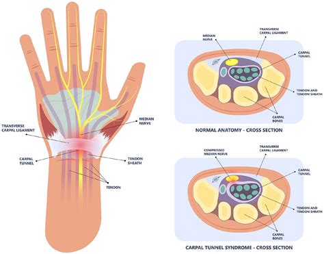 Median Nerve Assessment With Ultrasonography Cross Sectional Area