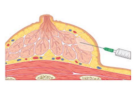 Surgical Oncology Flashcards Quizlet