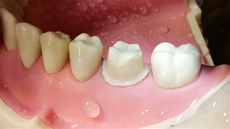 Molar Crown Preparation Walkthrough Tutorial In The Simulation Lab