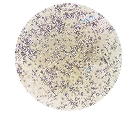 Yeast Cells In Urine