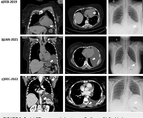 Figure From Large Pericardial Cyst Mimicking Recurrent Unilateral