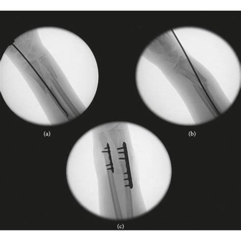 Intraoperative Fluoroscopic Images Showing Residual Fracture