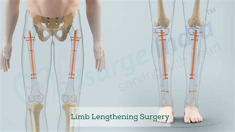 Limb Lengthening Surgery Cost In India Treatment And Procedure