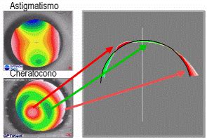 Topografia Corneale