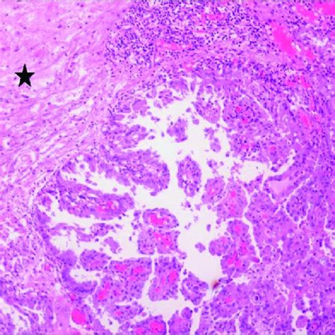 Metastasis Of Thyroid Papillary Carcinoma In The Brain Asterisk On The