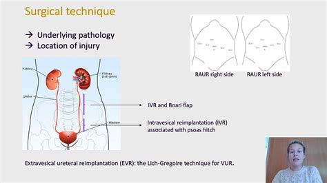 Ics 2020 Abstract 117 Robotic Ureteral Reimplantation For Mid And