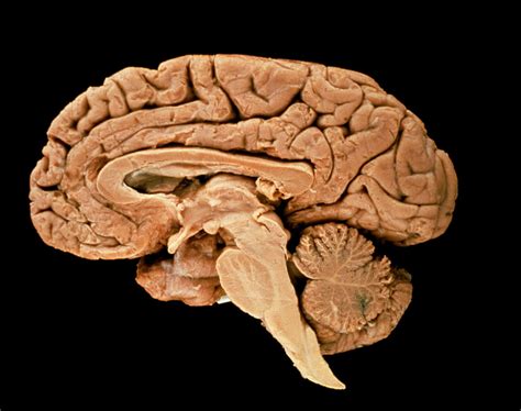 MS Brain Lesions and Their Effects