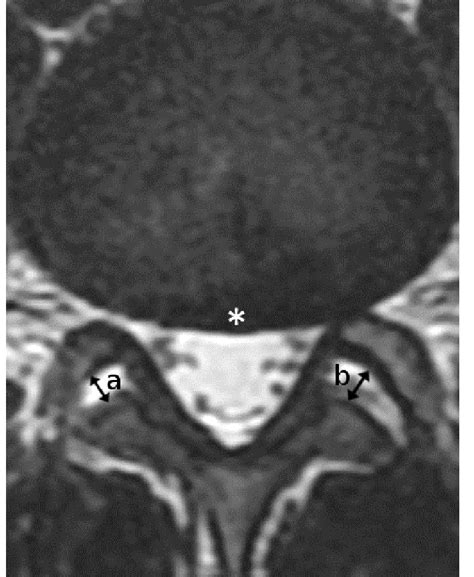 A facet joint effusion over 1.5 mm seen on MRI (supine MRI shown) may ...