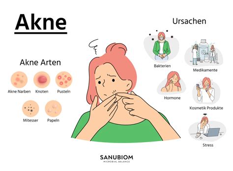 Akne Wissen Sanubiom