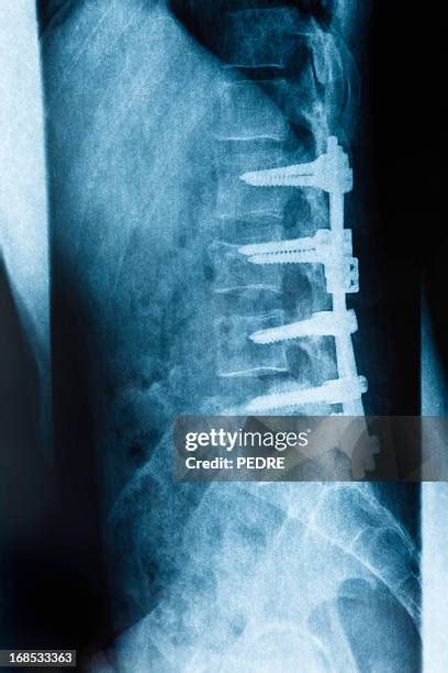 Broken Ribs Xray Photos and Premium High Res Pictures - Getty Images