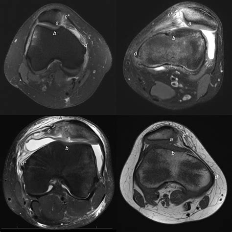 Arthroscopy Journal On Twitter After Patellar Dislocation There Are