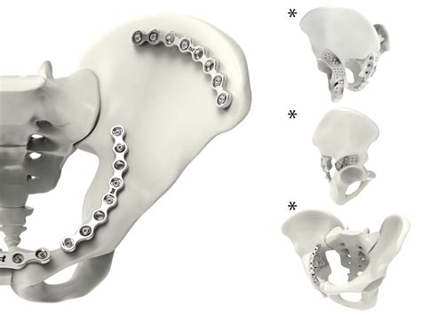 Pelvic Acetabulum Plates Tst