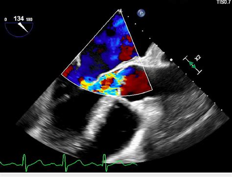 Perforation Of The Non Coronary Cusp With Severe Aortic Valve