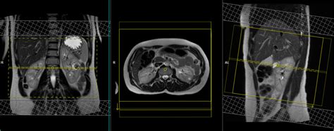 mri kidneys protocol renal mri protocol  planning