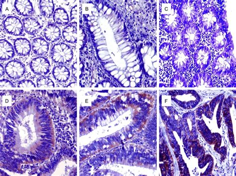 A-F. Normal mucosa (A), Hyperplastic Polyp (B), Tubular Adenoma (C ...