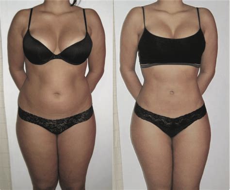 Liposuction Recovery Timeline Week By Week Results Guide [2024]