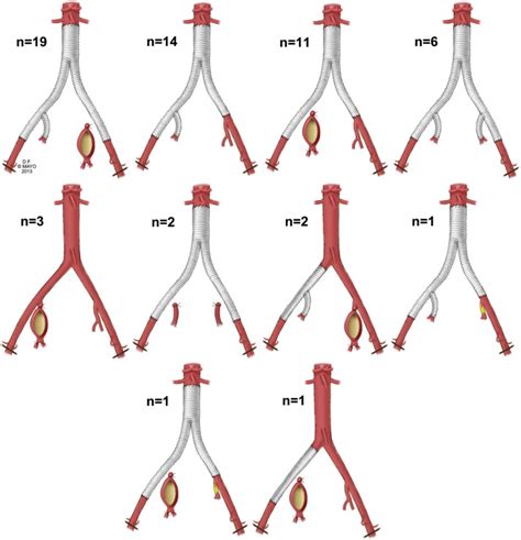 Outcomes Of Open And Endovascular Repair For Ruptured And Nonruptured