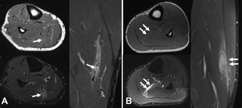 Two different cases of central tendon injury of the soleus. (A) Axial ...