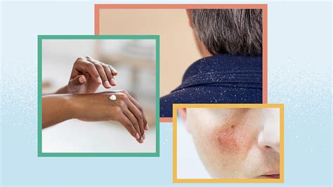 Rashes And Skin Conditions Associated With HIV And AIDS, 50% OFF