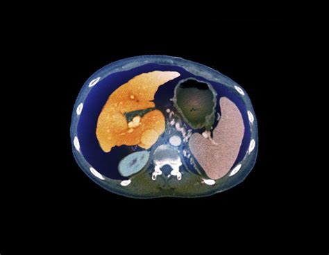 Chronic Liver Disease Ct Scan By Zephyr