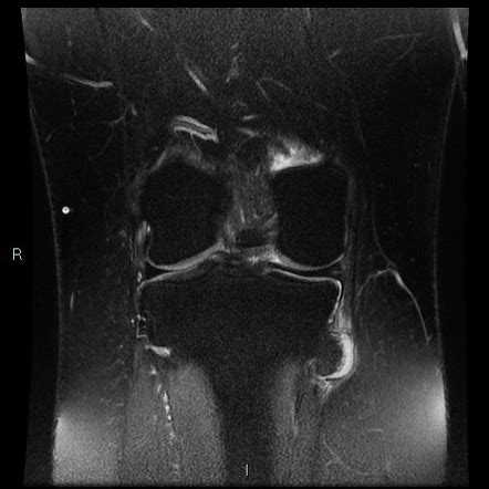 Osteochondroma Knee Radiology Case Radiopaedia Org