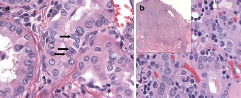 Papillary Thyroid Carcinoma Oncocytic Variant Adjacent To A Dominant