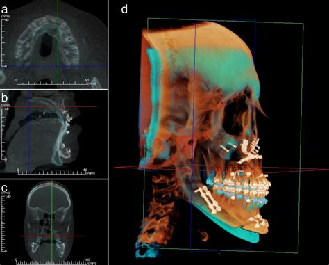 CT DENTAR YTS Dental View