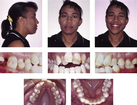 Category 7 Class Ii Skeletal Malocclusion With Transverse Maxillary